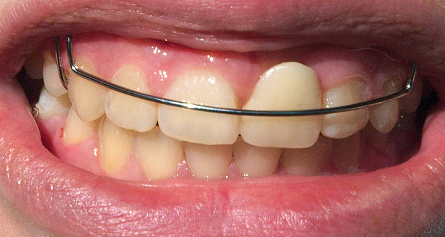 dental-retainer