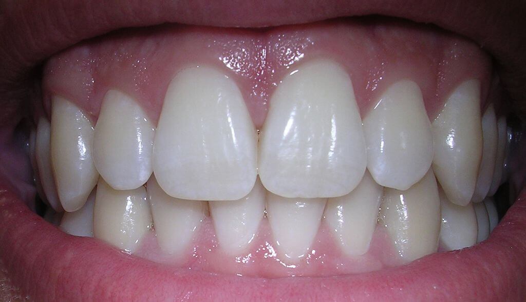 fluoride-teeth