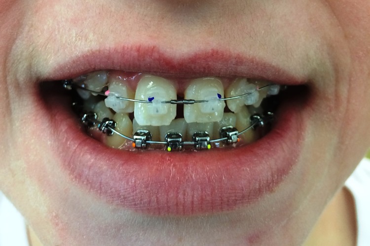 orthodontic-alloys