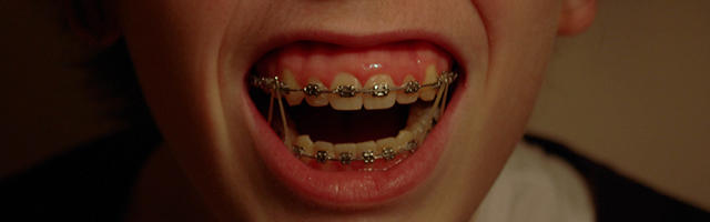 How To Convince Your Kids To Get Braces