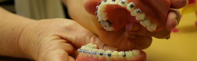 Tooth Extractions For Braces