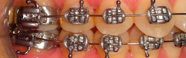 Tongue thrusts do NOT cause anterior open bite