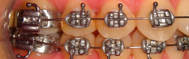 Arch Braces And How They Work