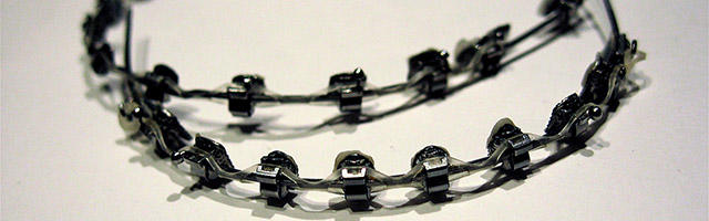 Discolouration after orthodontic treatment