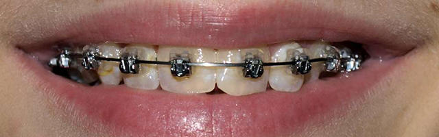 The Process of Orthodontic Treatment