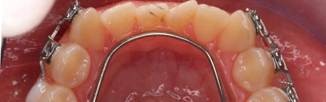 What are Lingual Braces?
