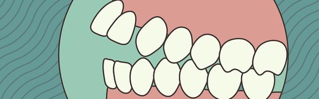 How to Treat Open Bite
