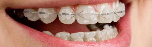 Fixed Metal Braces