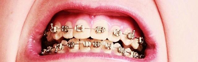 Celebrity Braces