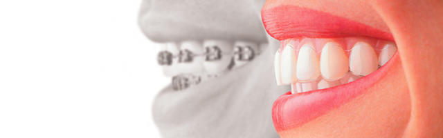 Veneers Or Braces