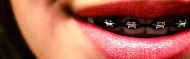 Brace Yourself For Orthodontics
