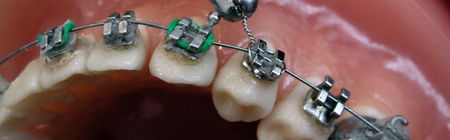 Oh No! My Bracket fell off!