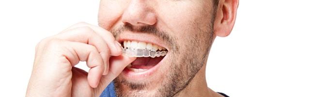 See Through Braces: Benefits
