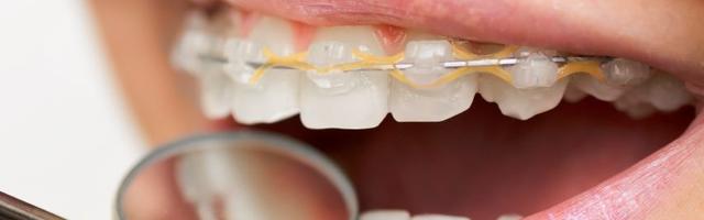 Can I Get Braces If I Have Fillings?
