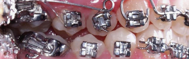 Orthodontic Problems and Solutions: Crowding