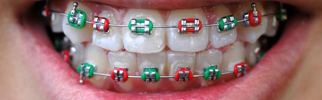 Colourful Braces Are In Fashion