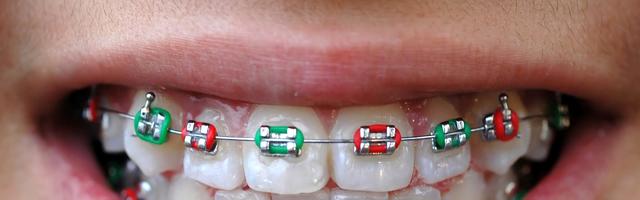 Orthodontic Alloys- What Braces Are Made Of