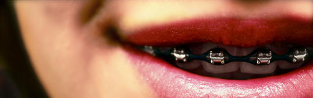 Orthodontics or dental veneers?