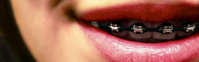 Fake Braces