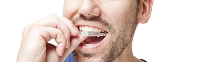 All You Need To Know About INVISALIGN® BRACES To Make An Informed Decision