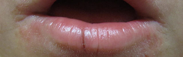 Orthodontic Problems and Solutions: Micrognathia and Macrognathia