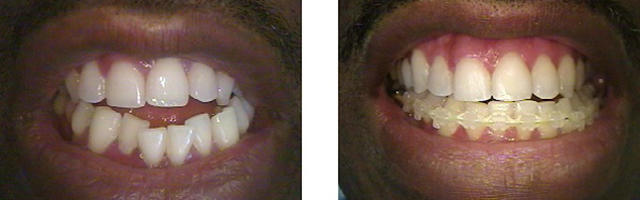Orthodontic Problems and Solutions: Open Bite