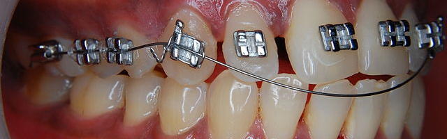 Orthodontic Problems and Solutions: Overbite