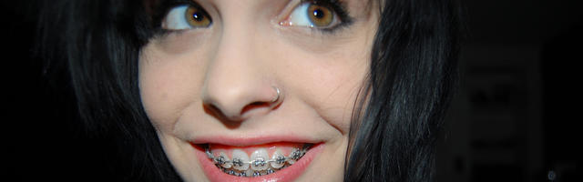 Braces Types and Treatment Types