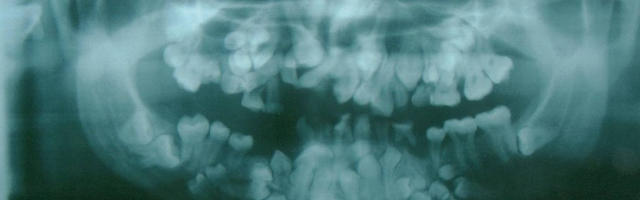 Supernumerary Teeth