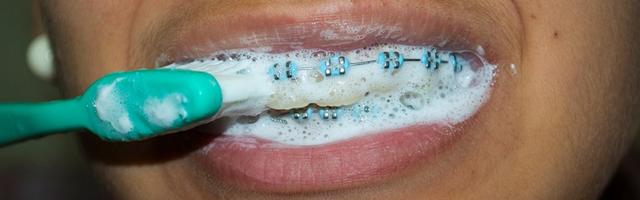 Gums Bleeding While Wearing Braces