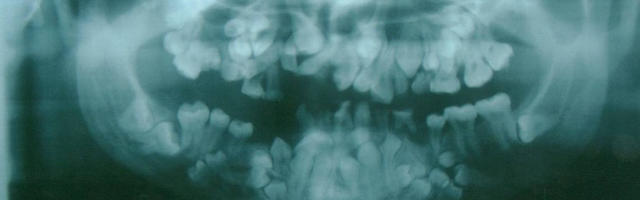 Orthodontic Problems and Solutions: Twisted Teeth