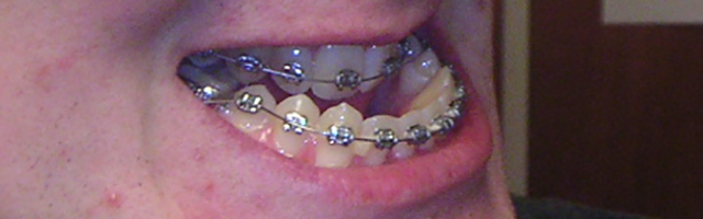 Orthodontic Problems and Solutions: Underbite