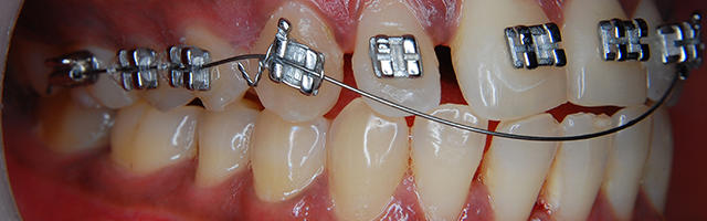 How Wisdom Teeth Can Affect Orthodontic Treatment