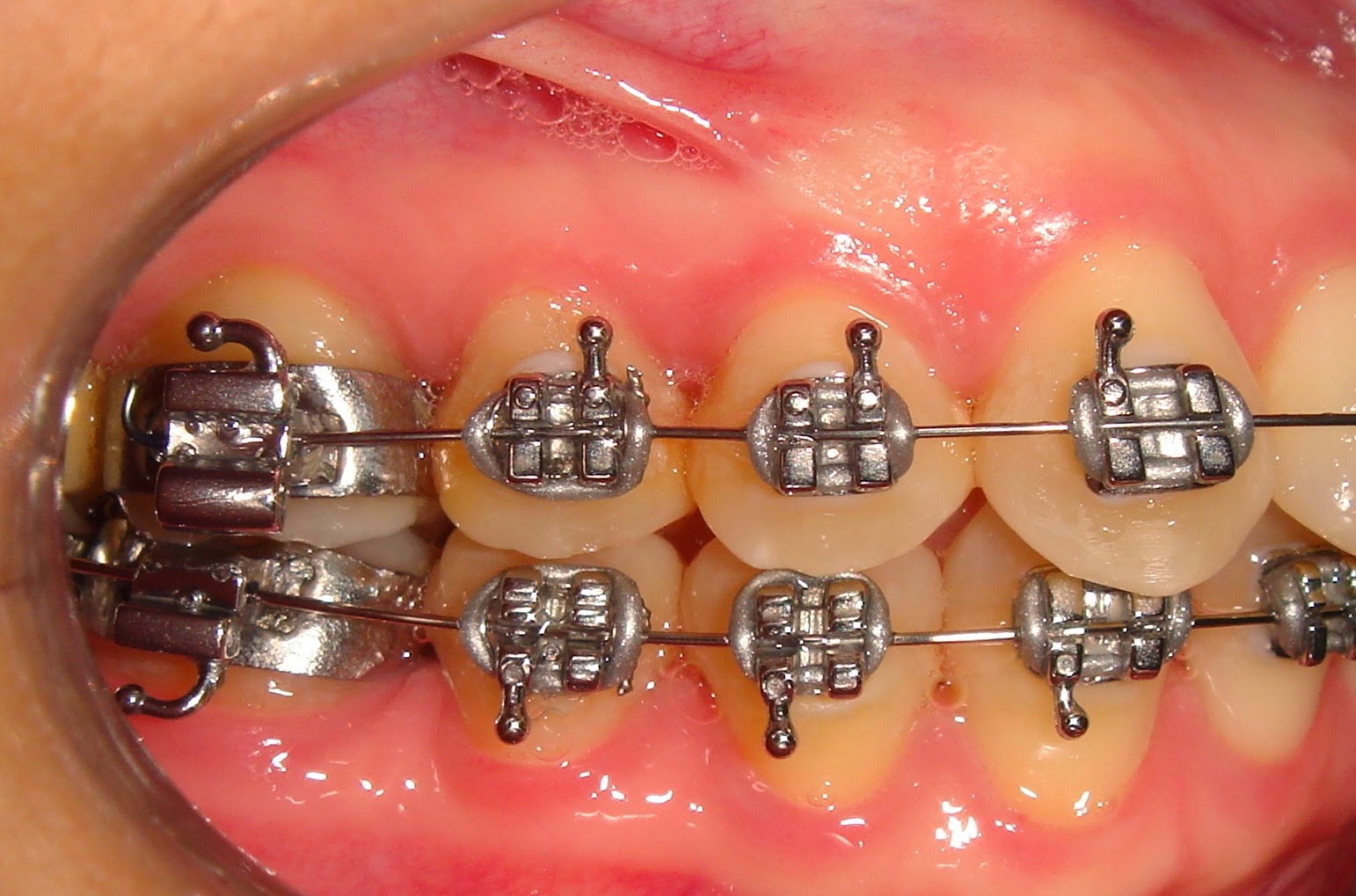 Arch Braces And How They Work