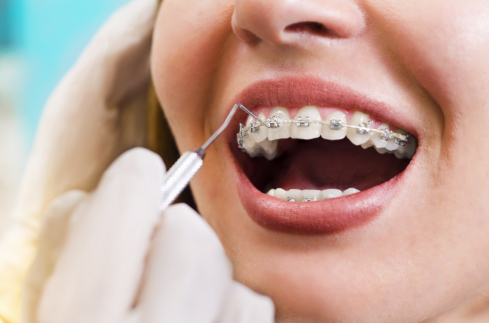 Metal Braces  Manchester Orthodontics