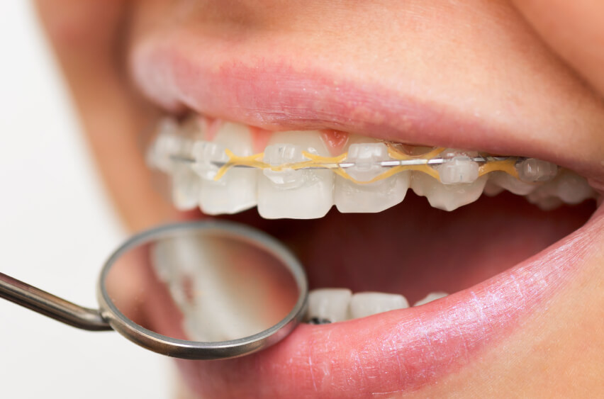 Caring For Your Braces Orthodontics In London