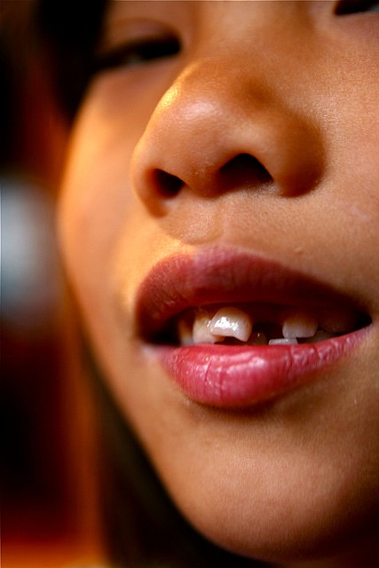 croked-tooth