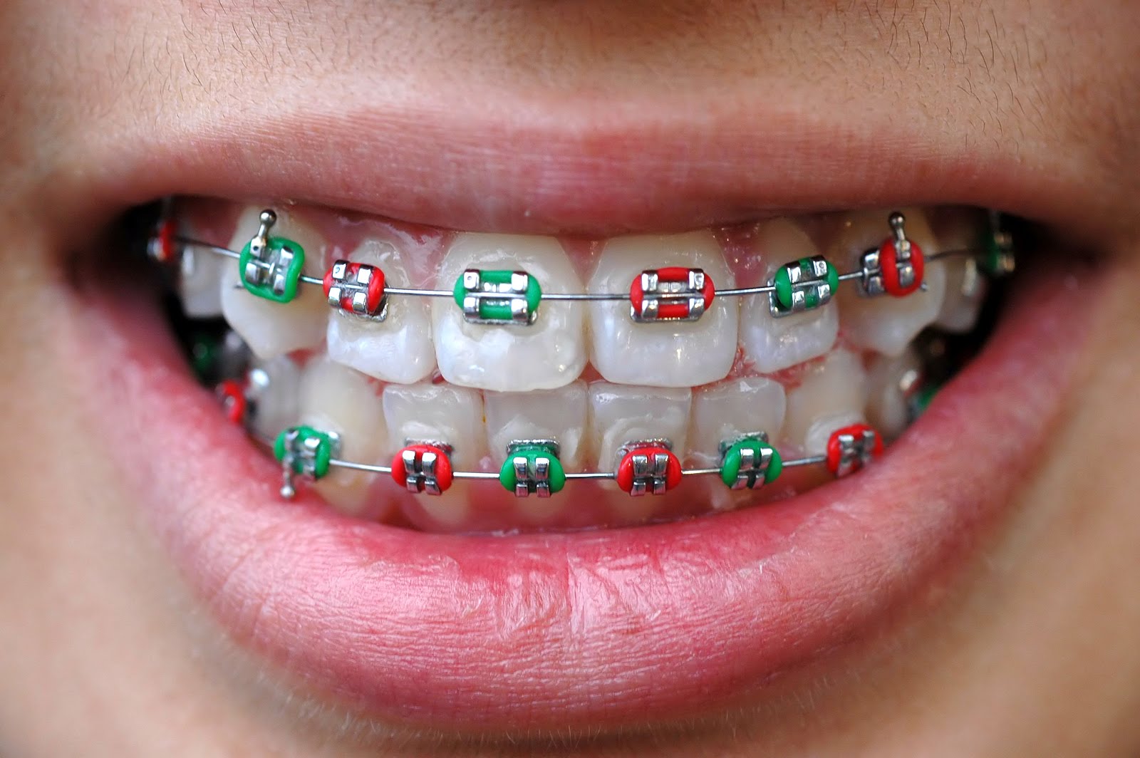 Colourful Braces Are In Fashion Orthodontics In London