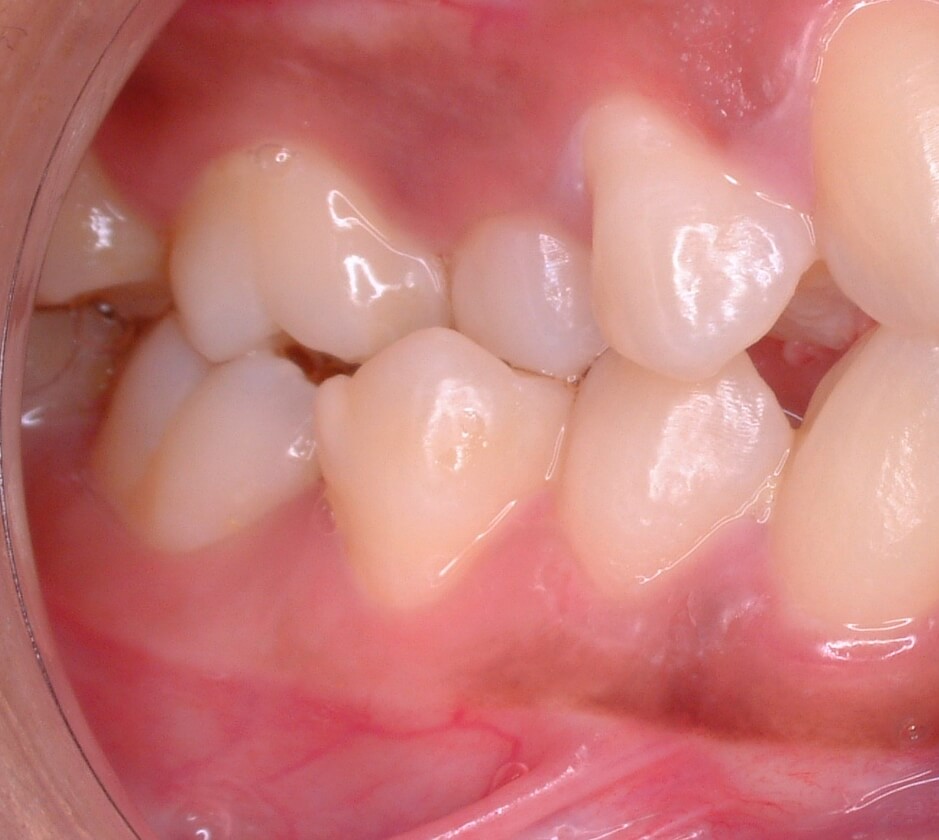 malocclusion bite