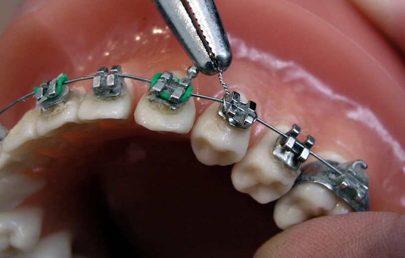 metal braces