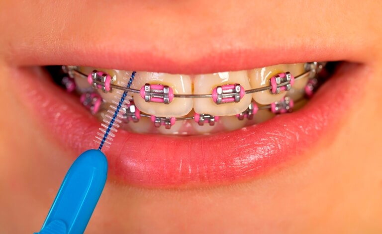 Membersihkan Braces- Global Estetik Dental Care