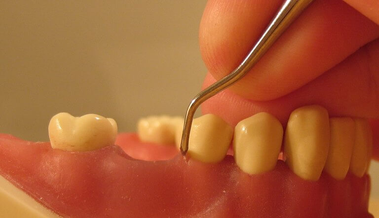 periodontitis