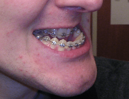 overbite correction rubber bands