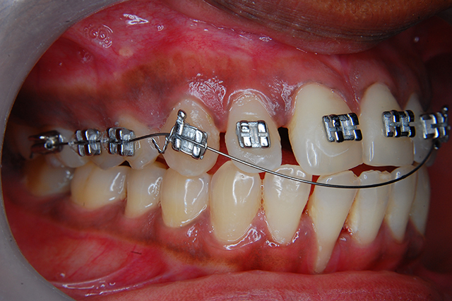 Orthodontics and braces - Wisdom