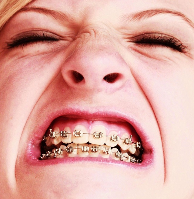 Celebrity Braces Orthodontics In London